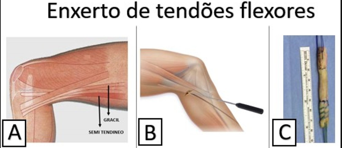 gracilsemi tensao.jpg