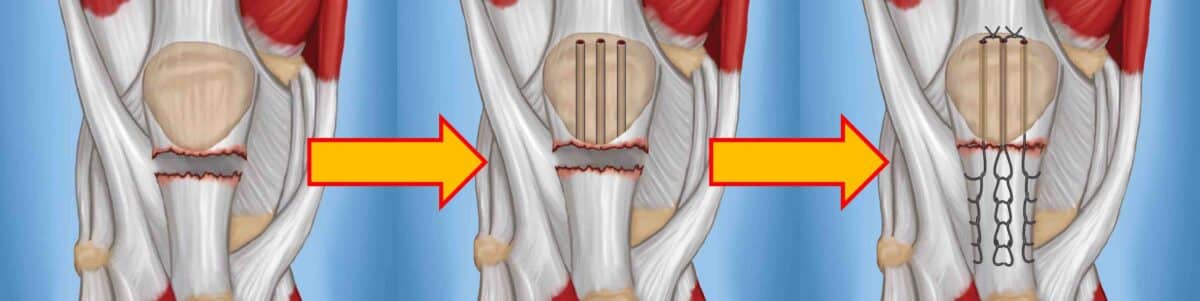 CIRURGIA-DA-ROTURA-DO-TENDAO-PATELAR-1200x301.jpg