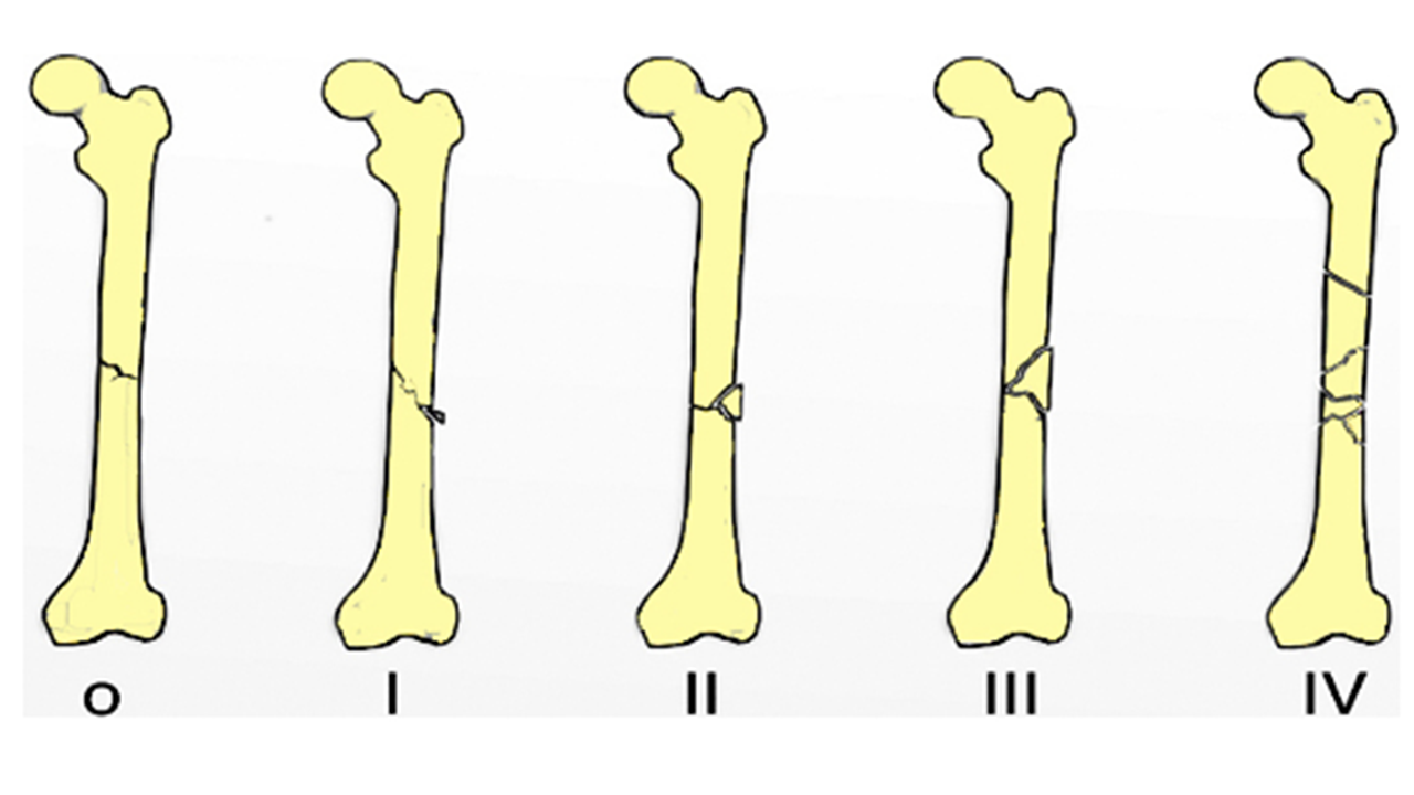 fratura diafise f.png