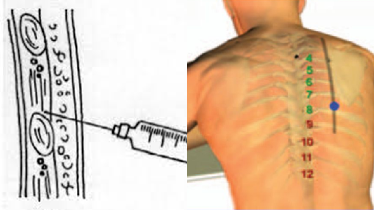 toracocentese.png