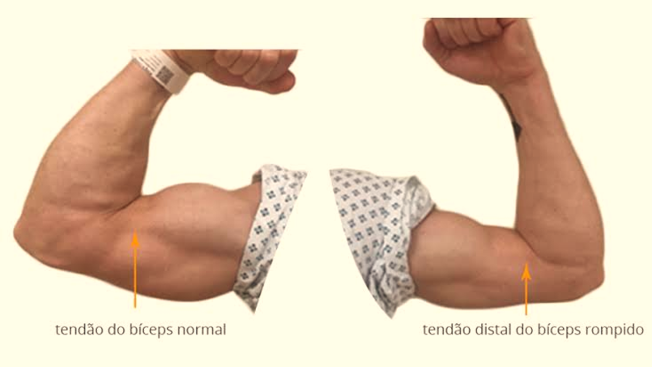 lesao bicipi.png