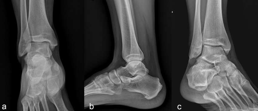 Basic-exam-to-take-in-ER-in-case-of-Ottawa-Ankle-Rules-positive-and-negative-exclusion.png