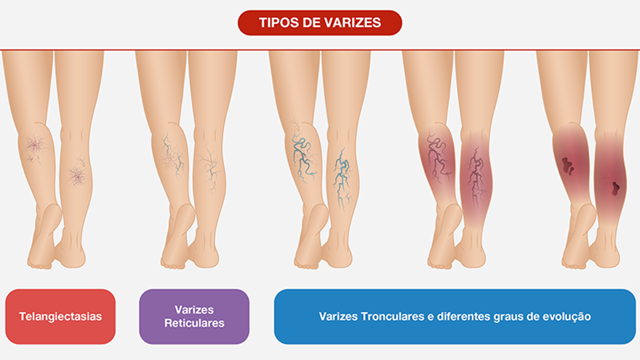tipos de varizes.png tipos de varizes.png