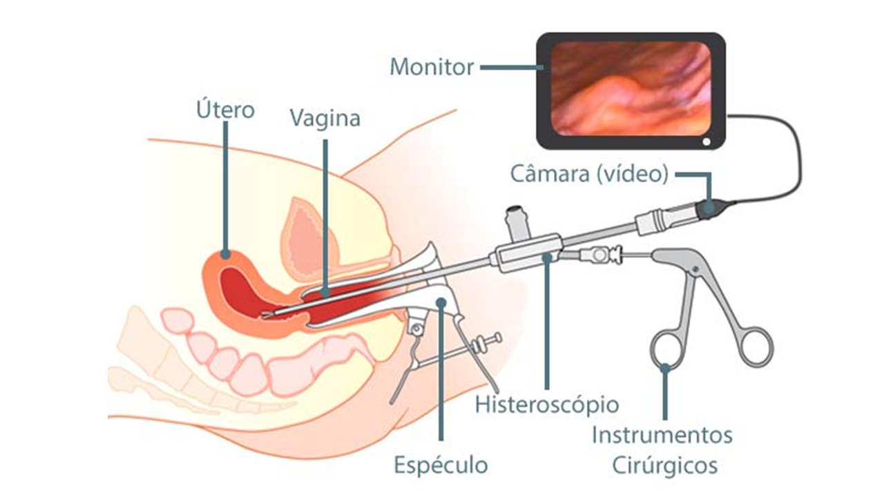 histeroscopaio1.png