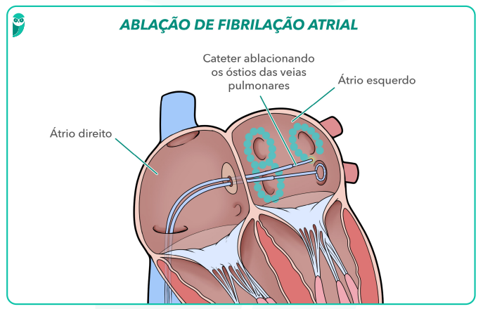FIB ATRIAL ABL.png