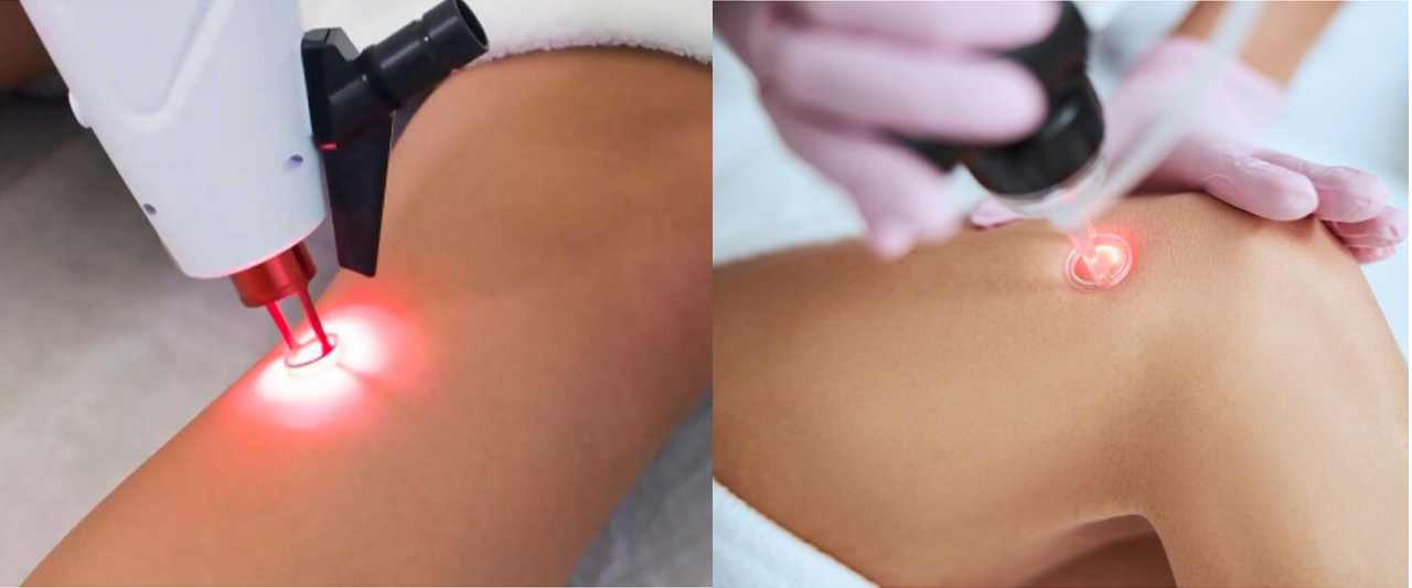 laser transdermico2.png laser transdermico2.png