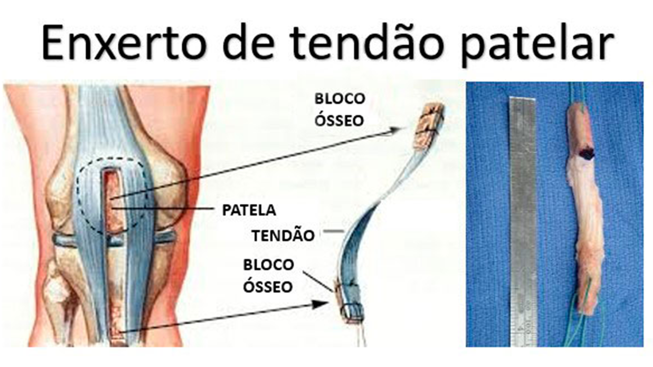 enxerto de ligamento patelar1.png
