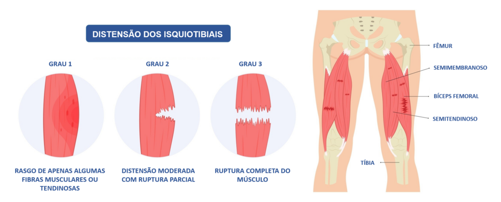 DISTENSAO-DOS-ISQUIOTIBIAIS-1024x414.png